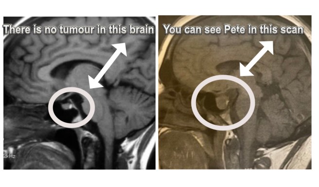 A Tumour named&nbsp;Pete